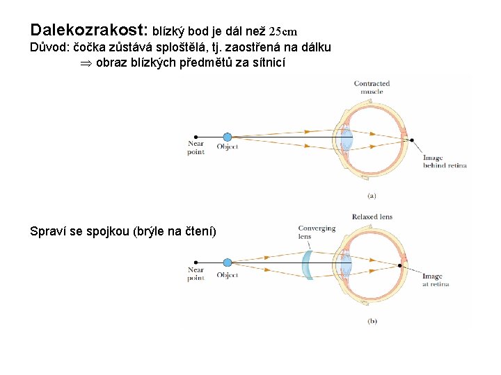 Dalekozrakost: blízký bod je dál než 25 cm Důvod: čočka zůstává sploštělá, tj. zaostřená Dalekozrakost: blízký bod je dál než 25 cm Důvod: čočka zůstává sploštělá, tj. zaostřená