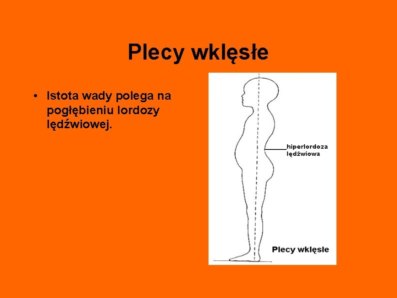 Plecy wklęsłe • Istota wady polega na pogłębieniu lordozy lędźwiowej. 