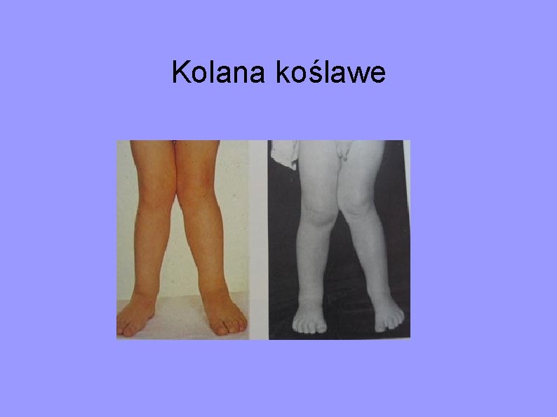 Kolana koślawe 