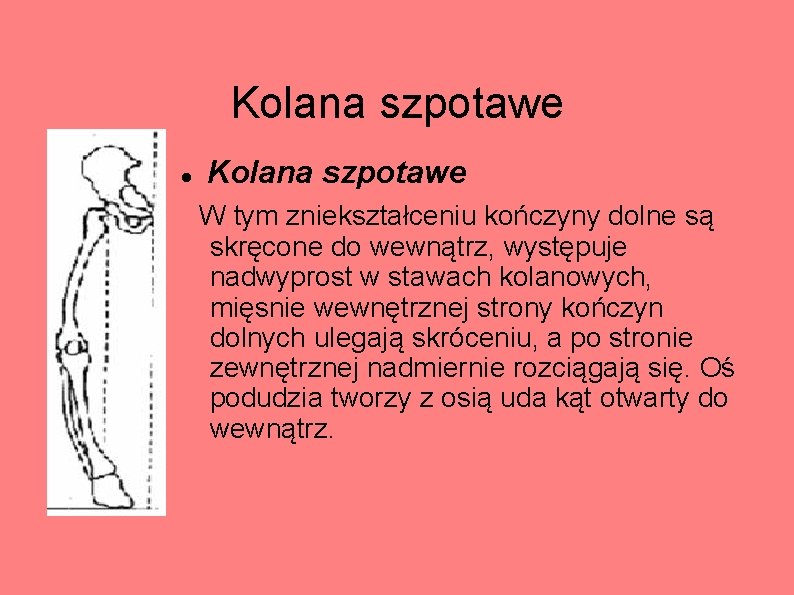 Kolana szpotawe W tym zniekształceniu kończyny dolne są skręcone do wewnątrz, występuje nadwyprost w