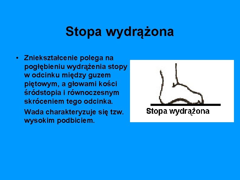 Stopa wydrążona • Zniekształcenie polega na pogłębieniu wydrążenia stopy w odcinku między guzem piętowym,