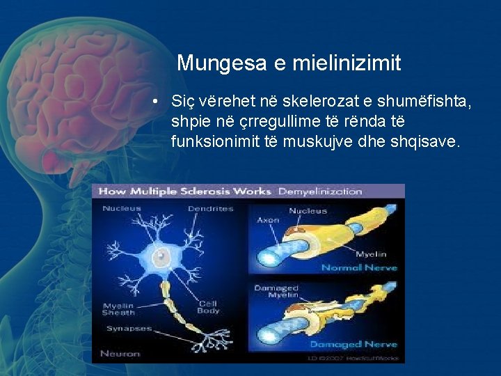Mungesa e mielinizimit • Siç vërehet në skelerozat e shumëfishta, shpie në çrregullime të Mungesa e mielinizimit • Siç vërehet në skelerozat e shumëfishta, shpie në çrregullime të