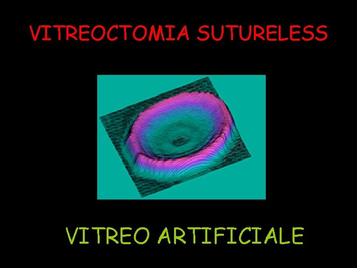 VITREOCTOMIA SUTURELESS VITREO ARTIFICIALE 