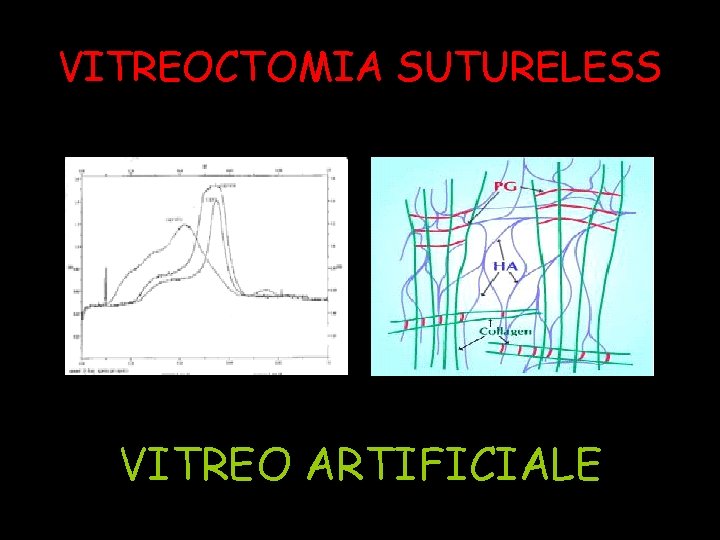 VITREOCTOMIA SUTURELESS VITREO ARTIFICIALE 