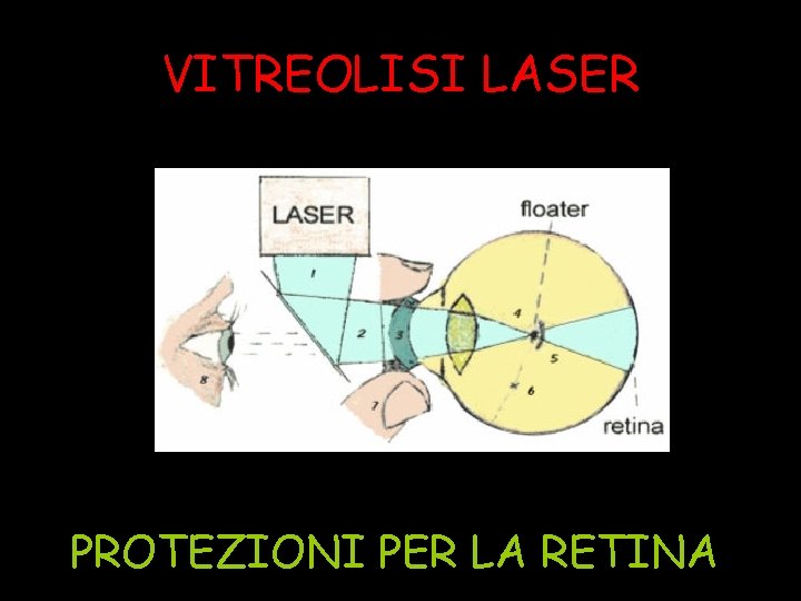 VITREOLISI LASER PROTEZIONI PER LA RETINA 