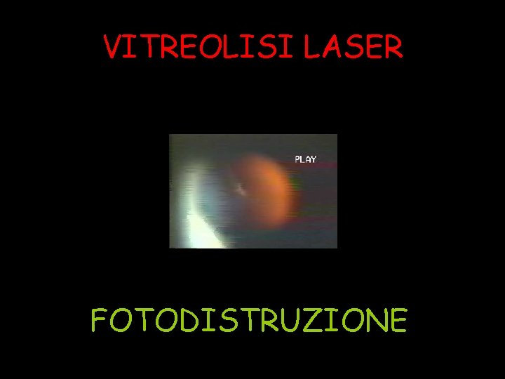 VITREOLISI LASER FOTODISTRUZIONE 