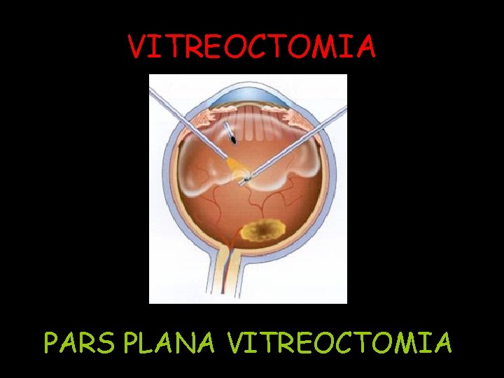 VITREOCTOMIA PARS PLANA VITREOCTOMIA 