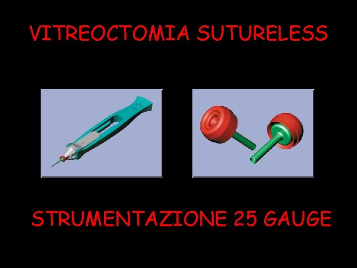 VITREOCTOMIA SUTURELESS STRUMENTAZIONE 25 GAUGE 