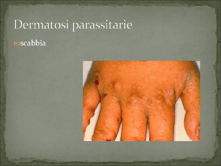 Dermatosi parassitarie scabbia 