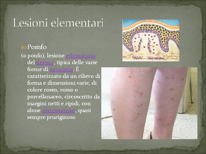 Lesioni elementari Pomfo (o ponfo), lesione edematosa del derma, tipica delle varie forme di