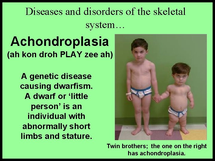 Diseases and disorders of the skeletal system… Achondroplasia (ah kon droh PLAY zee ah)