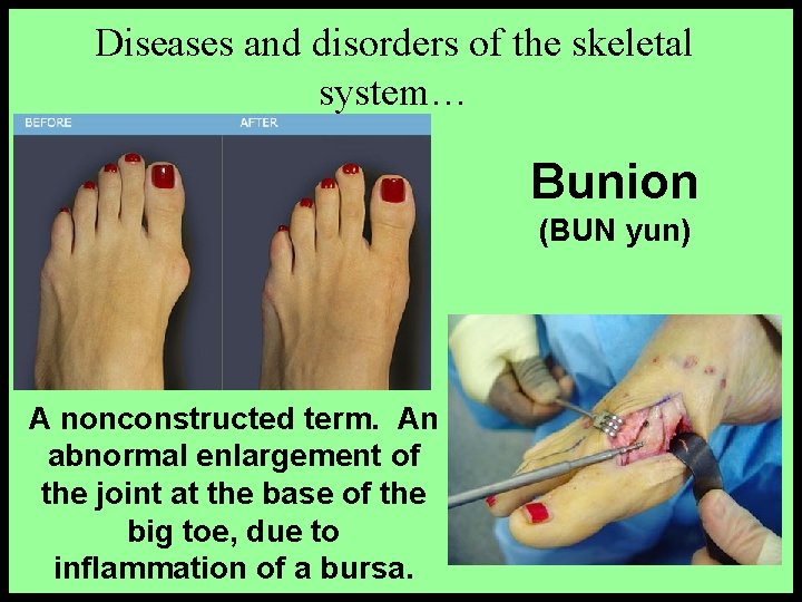 Diseases and disorders of the skeletal system… Bunion (BUN yun) A nonconstructed term. An