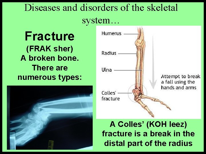 Diseases and disorders of the skeletal system… Fracture (FRAK sher) A broken bone. There