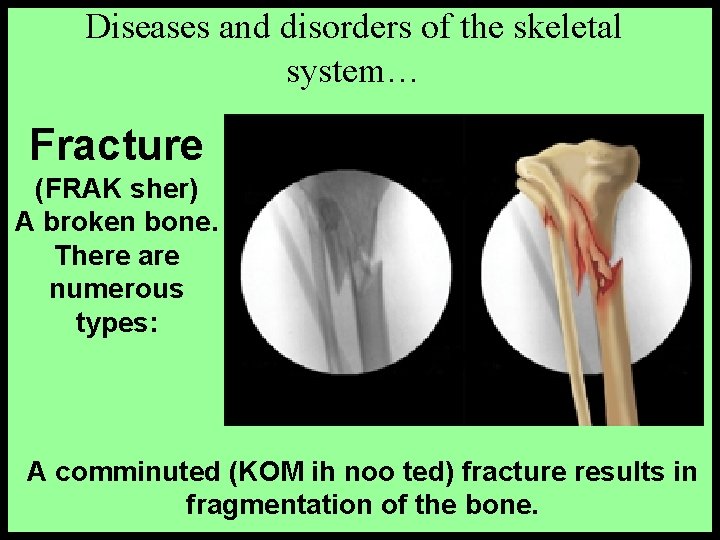 Diseases and disorders of the skeletal system… Fracture (FRAK sher) A broken bone. There