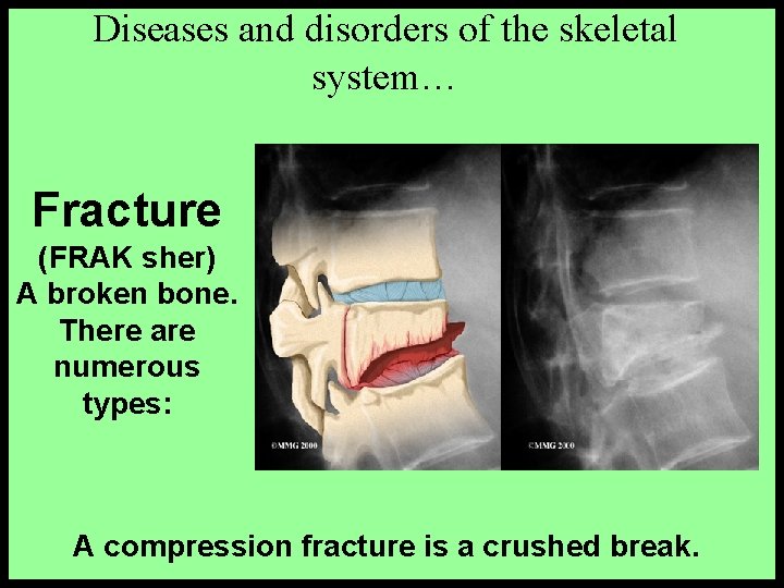 Diseases and disorders of the skeletal system… Fracture (FRAK sher) A broken bone. There