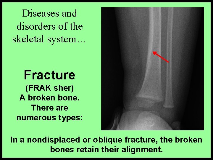 Diseases and disorders of the skeletal system… Fracture (FRAK sher) A broken bone. There