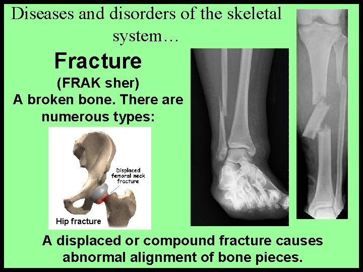 Diseases and disorders of the skeletal system… Fracture (FRAK sher) A broken bone. There