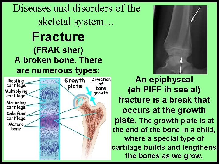 Diseases and disorders of the skeletal system… Fracture (FRAK sher) A broken bone. There