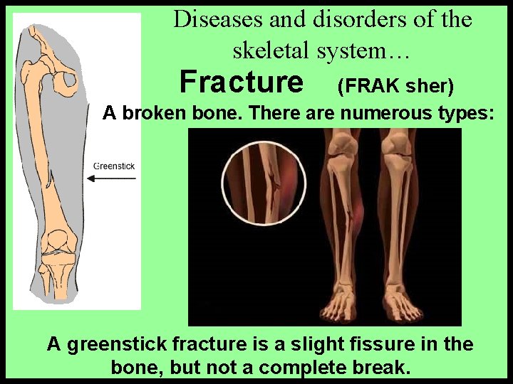 Diseases and disorders of the skeletal system… Fracture (FRAK sher) A broken bone. There