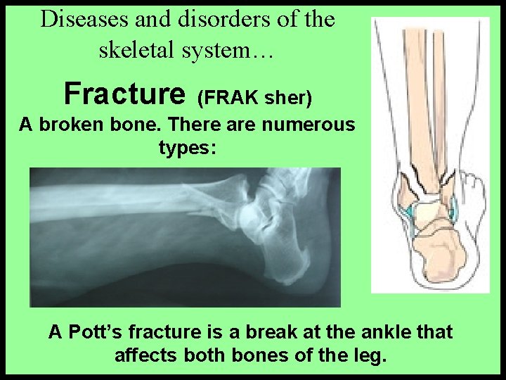 Diseases and disorders of the skeletal system… Fracture (FRAK sher) A broken bone. There