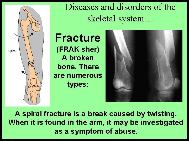 Diseases and disorders of the skeletal system… Fracture (FRAK sher) A broken bone. There