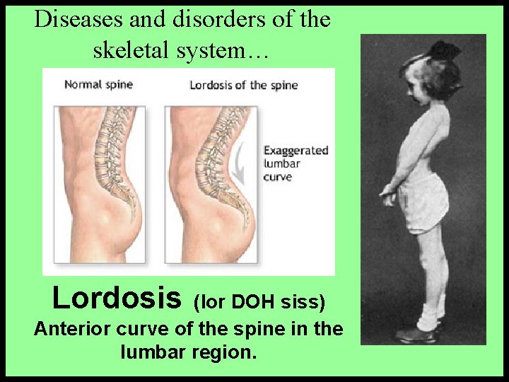Diseases and disorders of the skeletal system… Lordosis (lor DOH siss) Anterior curve of