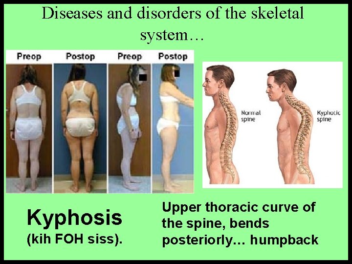 Diseases and disorders of the skeletal system… Kyphosis (kih FOH siss). Upper thoracic curve