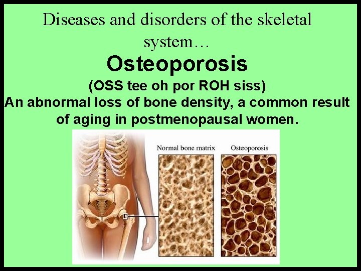 Diseases and disorders of the skeletal system… Osteoporosis (OSS tee oh por ROH siss)