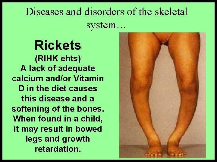 Diseases and disorders of the skeletal system… Rickets (RIHK ehts) A lack of adequate