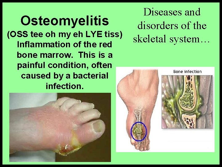 Osteomyelitis (OSS tee oh my eh LYE tiss) Inflammation of the red bone marrow.