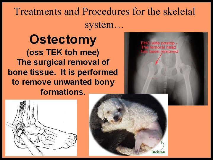 Treatments and Procedures for the skeletal system… Ostectomy (oss TEK toh mee) The surgical