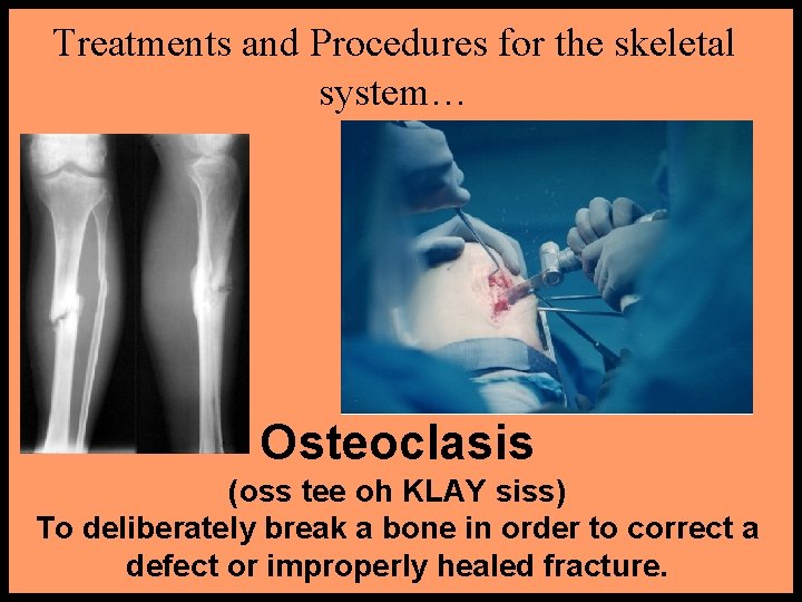 Treatments and Procedures for the skeletal system… Osteoclasis (oss tee oh KLAY siss) To