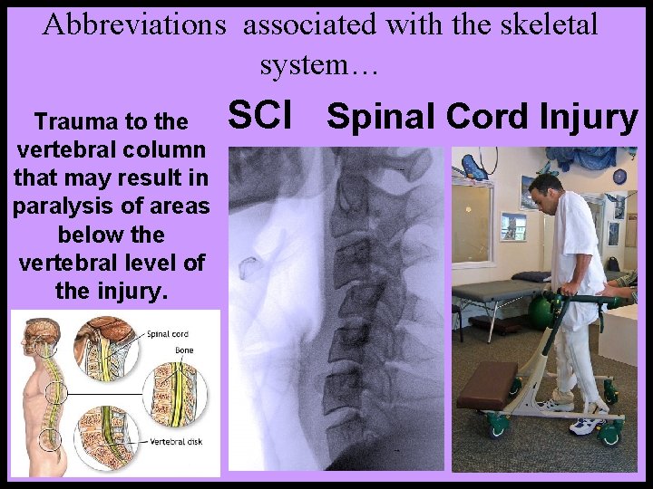 Abbreviations associated with the skeletal system… Trauma to the vertebral column that may result