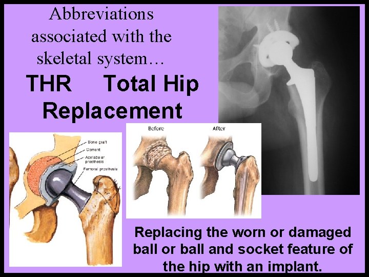 Abbreviations associated with the skeletal system… THR Total Hip Replacement Replacing the worn or