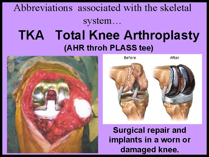 Abbreviations associated with the skeletal system… TKA Total Knee Arthroplasty (AHR throh PLASS tee)