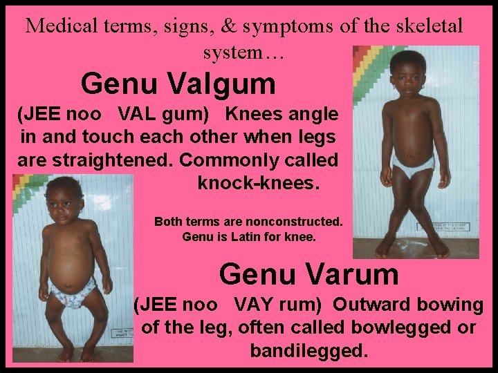 Medical terms, signs, & symptoms of the skeletal system… Genu Valgum (JEE noo VAL