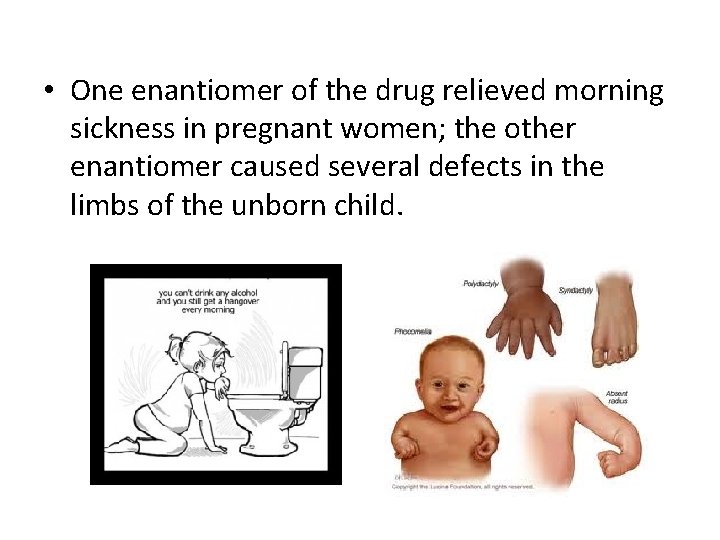  • One enantiomer of the drug relieved morning sickness in pregnant women; the