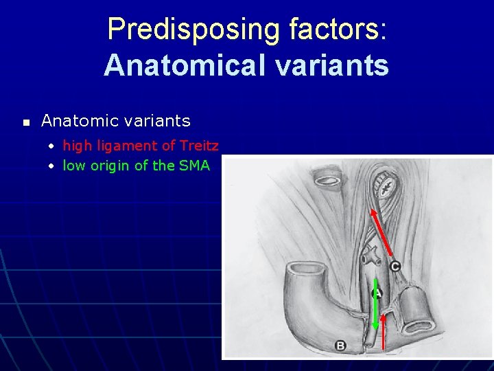 Predisposing factors: Anatomical variants n Anatomic variants • high ligament of Treitz • low