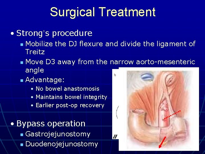 Surgical Treatment • Strong’s procedure Mobilize the DJ flexure and divide the ligament of