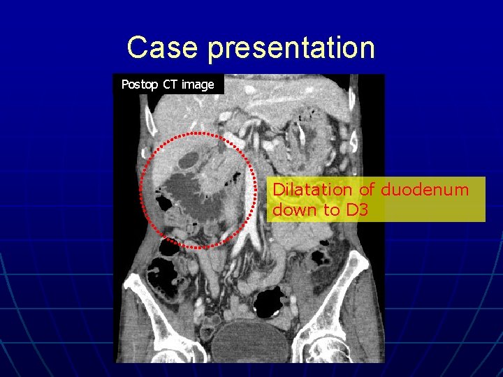 Case presentation Postop CT image Dilatation of duodenum down to D 3 