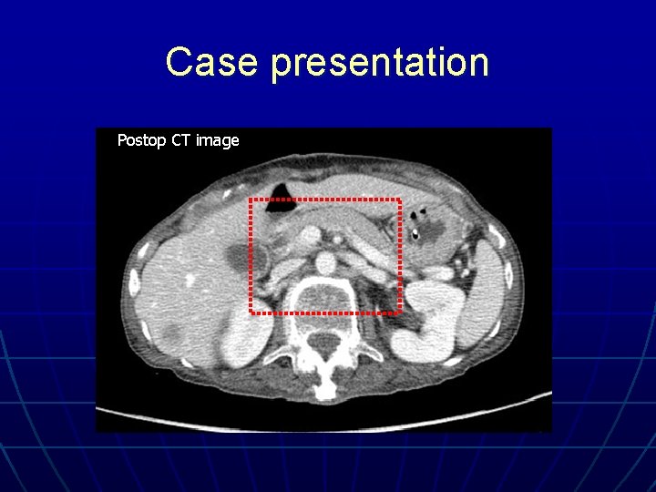 Case presentation Postop CT image 