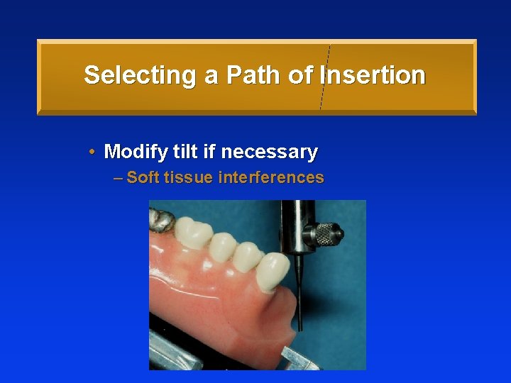 Selecting a Path of Insertion • Modify tilt if necessary – Soft tissue interferences