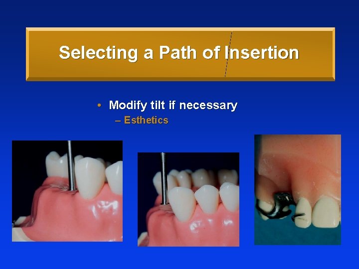 Selecting a Path of Insertion • Modify tilt if necessary – Esthetics 