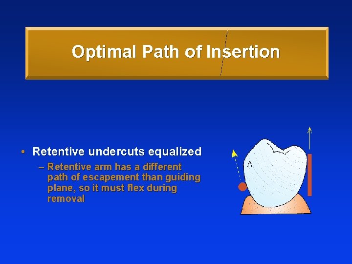 Optimal Path of Insertion • Retentive undercuts equalized – Retentive arm has a different