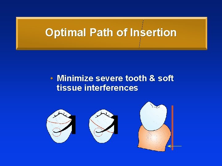 Optimal Path of Insertion • Minimize severe tooth & soft tissue interferences 