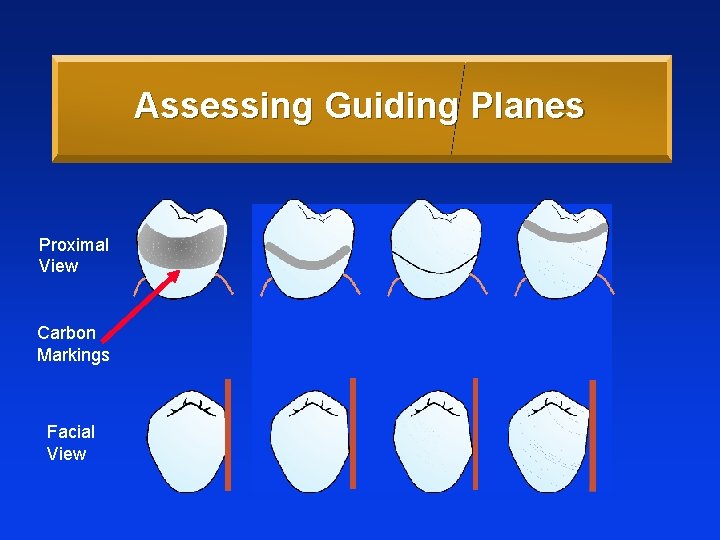 Assessing Guiding Planes Proximal View Carbon Markings Facial View 