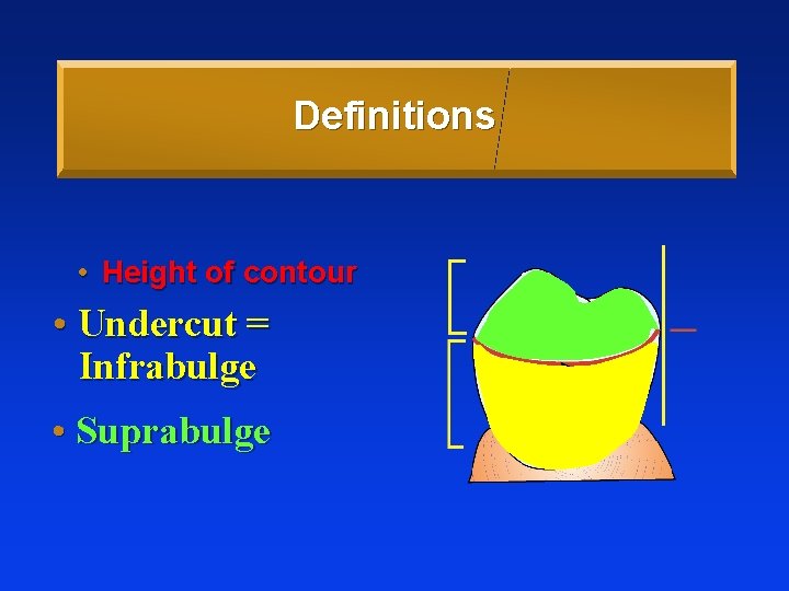 Definitions • Height of contour • Undercut = Infrabulge • Suprabulge 