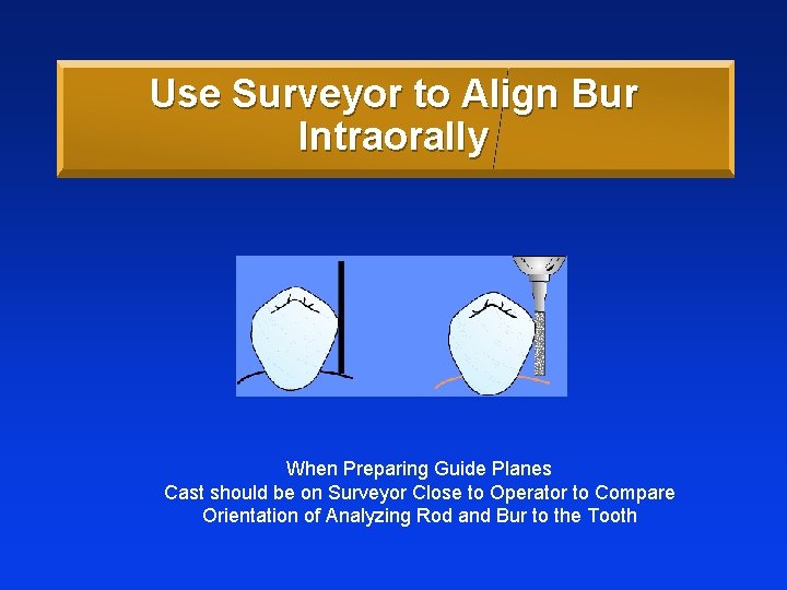 Use Surveyor to Align Bur Intraorally When Preparing Guide Planes Cast should be on