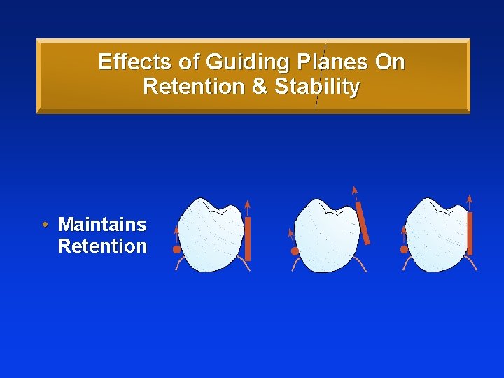 Effects of Guiding Planes On Retention & Stability • Maintains Retention 