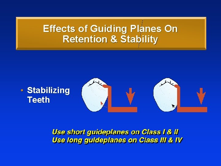 Effects of Guiding Planes On Retention & Stability • Stabilizing Teeth 